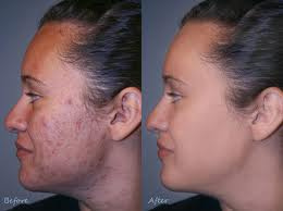 Come mascherare un tempo su una faccia per mezzo di cosmetici